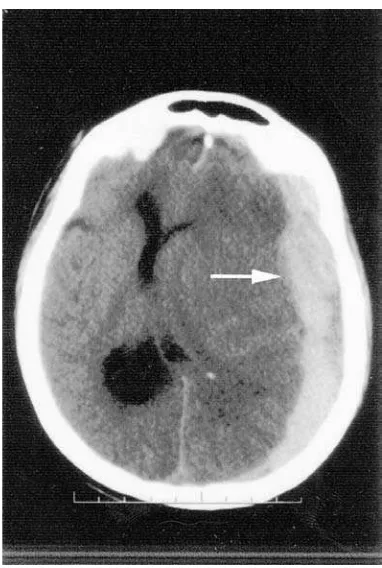 Gambar 2.9 Perdarahan Subdural Akut 