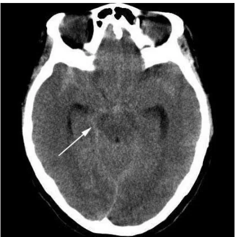 Gambar 2.10 Perdarahan Subaraknoid 