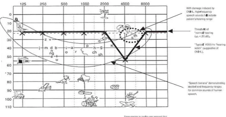 Gambar 2.3 Audiogram standar dengan “menggambarkan pola ciri khas GPAB pada pekerja di frekuensi 4000 Hz speech banana” yang (Kurmis & Apps, 2007)