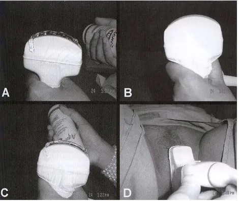 Figure 1. Preparing curve transducer for ultrasoundtranslabial. After wetting the transducer with gel (A), thetransducer is then coated with free-powder rubber gloves(B)