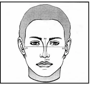Gambar 8. Pengukuran Upper Facial Index.15 