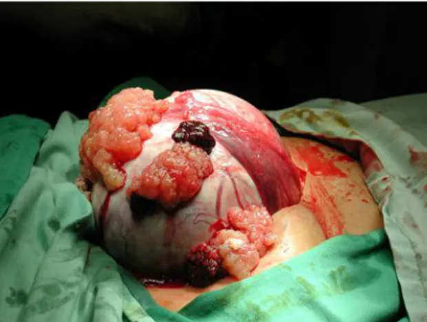 Gambar 14.2 Tumor ovarium besar pada saat  operasi