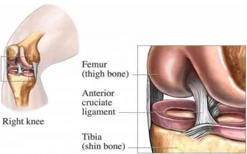 Gambar 1.  Cedera anterior cruciate ligament (ACL) 
