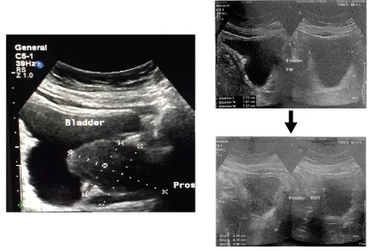 Gambar 2 Pasien dengan LUTS Sedang, didapatkan Pengukuran IPP: 8,2 mm (Derajat II: 5-10mm), dengan volume urine pre-miksi: 180 ml, volume urine post miksi didapatkan PVR sebesar 22,6 ml.