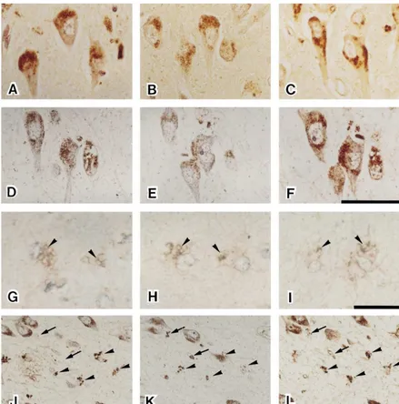 Fig. 3. Representative AGE-immuopositive granules in hippocampal neurons from AD (A), DM (B), and control brains (C)
