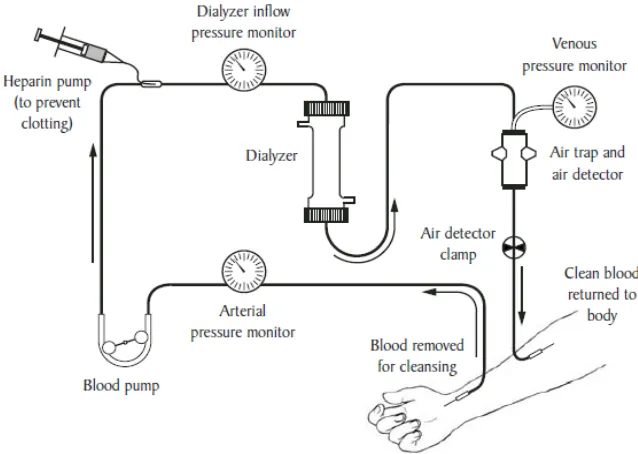 Gambar 1.1 Sirkulasi darah pada proses hemodialisis  
