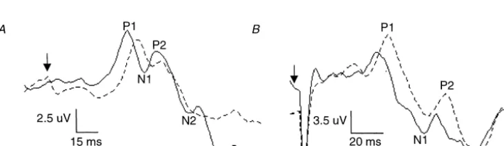 Fig. 1. Averaged SEP response traces showing the effect of cooling. Averaged traces (n560 samples) from one subject following tibial (A) and sural nerve(B) stimulation in the warmed (—) and most cooled (- - -) state