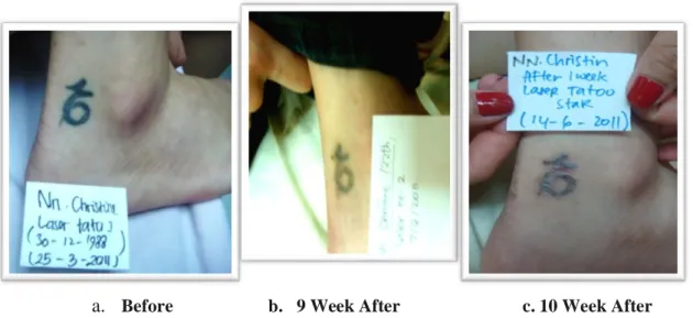 Figure 4 (a, b, c) First treatment using Qs NdYag 1064 nm. 6. 2 J. Spot Size 3  (Fig.1), 9 week after is 