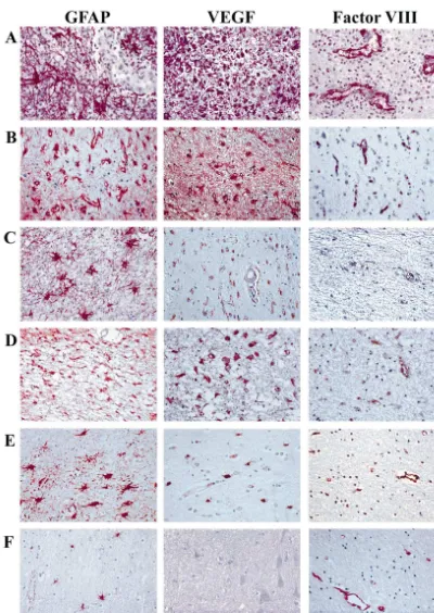 Fig. 1. Astrocytosis and neoangiogenesis in human CNS disease. Photomicrographs (scale bar depicts 50 mm in length) illustrating immunohistochemicalstaining of a spectrum of human neuropathological disease states with: Row A — Brain Abscess; Row B — Alzhei