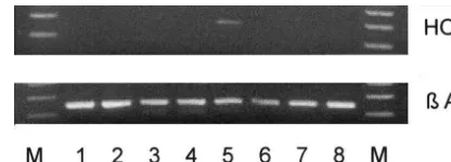 Fig. 2. HO-1 mRNA was observed in one WHO grade IV glioblastomamultiforme relapse (lane 5), but not in oligodendrogliomas (lanes 1–3),anaplastic oligodendroglioma (lane 4) or three other glioblastomas (lanes6–8).
