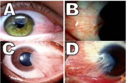 Gambar 2. Stadium pterigium, stadium 1(A), stadium 2 (B), stadium 3 (C), stadium 4 (D) 