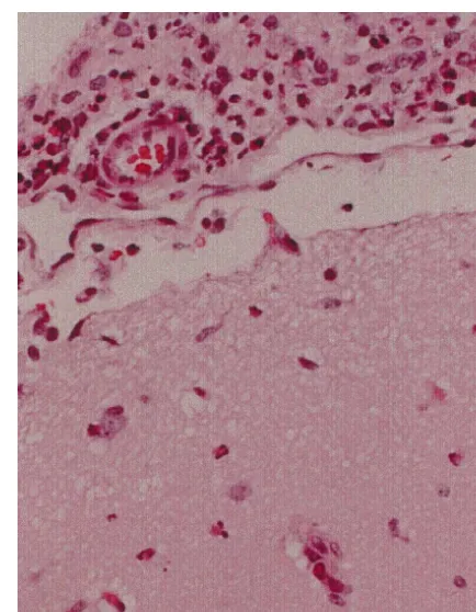 Fig. 1. Parafﬁn embedded microscopic section (3hematoxylin-eosin of a rabbit brain infected with Group B Streptococcus.There is a thick inﬁltrate of polymorphonuclear cells present in thesubarachnoid space