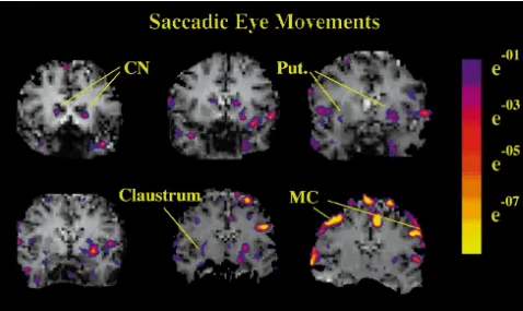 Fig. 6. Caudate nucleus activation by saccadic eye movements. Signiﬁcance maps of six contiguous slices during saccadic eye movements in a singlesubject
