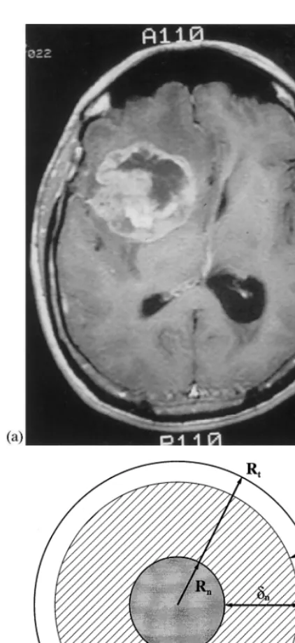 Fig. 1. (a) MRI brain scan showing a GBM tumor (the lightarea on the top right). The enhanced ring contains highlymetabolizing (i.e