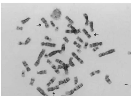 Figure 1. Karyotype of the case showing three Xs.