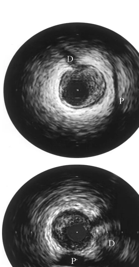 Fig. 1. Orientation of eccentric plaques using IVUS landmarks. In theleft anterior descending coronary artery the location of the peri-cardium is frequently directly apparent