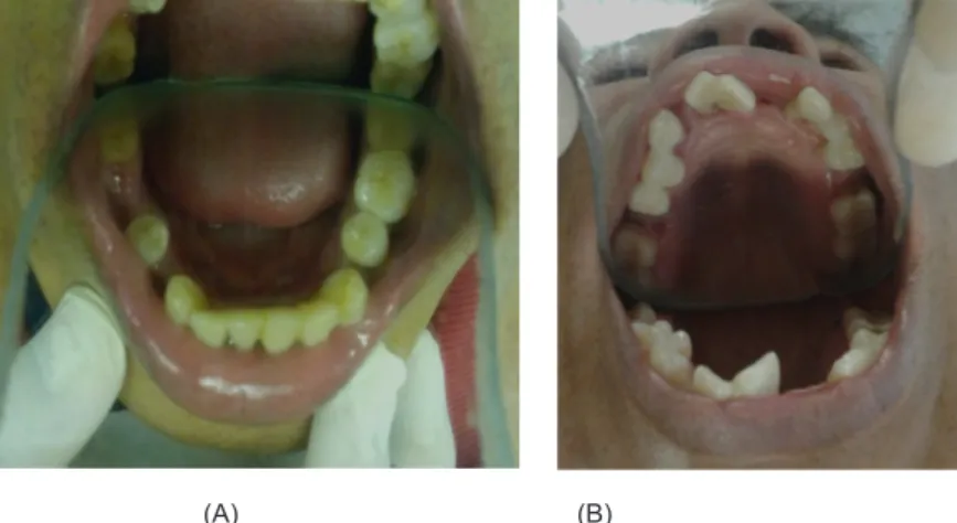 Gambar 2. (A) Kondisi intra oral rahang atas (B) Kondisi intra oral rahang bawah