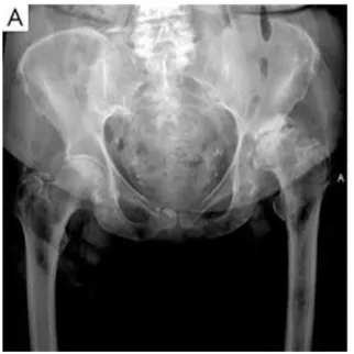 Fig 4. Xray post operative Total hip arthroplasty and acetabuloplasty