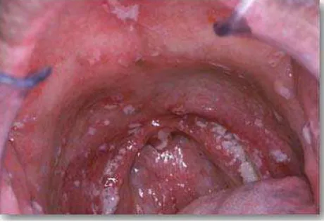 Gambar 4. Kandidiasis oral.21 