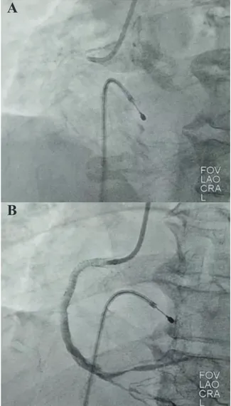 Gambar 5. Gambaran Digital Coronary Angiography  sebelum (A) dan setelah (B) tindakan PCI