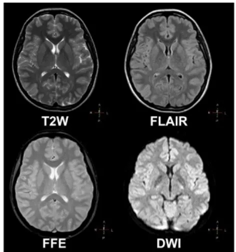 Gambar 5. MRI Kepala tanpa kontras 