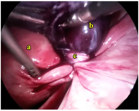 Gambar 5.7 (b) Torsi kista ovarium kanan. (a) uterus, (b)  gangren ovarium kanan, (c) pedikel bengkok