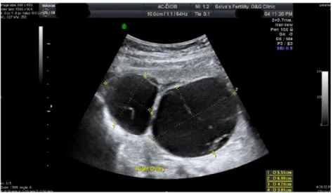Gambar 5.9 Gambar USG menunjukkan 2 kista pada ovarium kanan