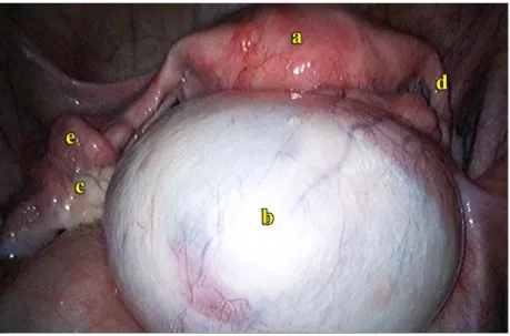 Gambar 5.5 (b) kistadenoma kanan (a) uterus, (b) kistadenoma kanan, (c)  ovarium normal kiri, (d) tuba falopi kanan, (e) tuba falopi kiri