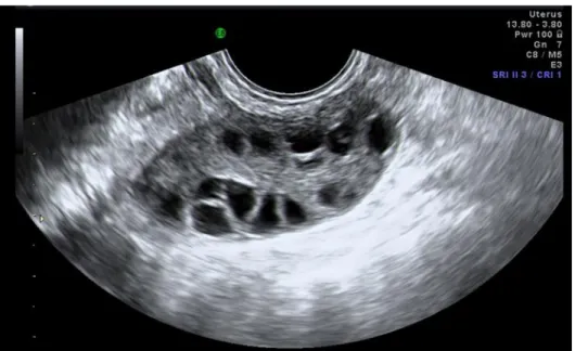 Gambar 5.6 Gambar USG menunjukkan Penyakit Ovarium Polikistik