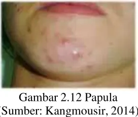 Gambar 2.12 Papula 