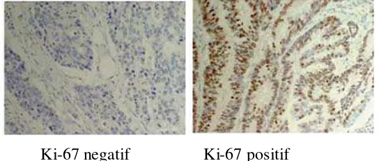 Gambar 3.3  : Ekspresi Ki-67 dengan pemeriksaan IHC  