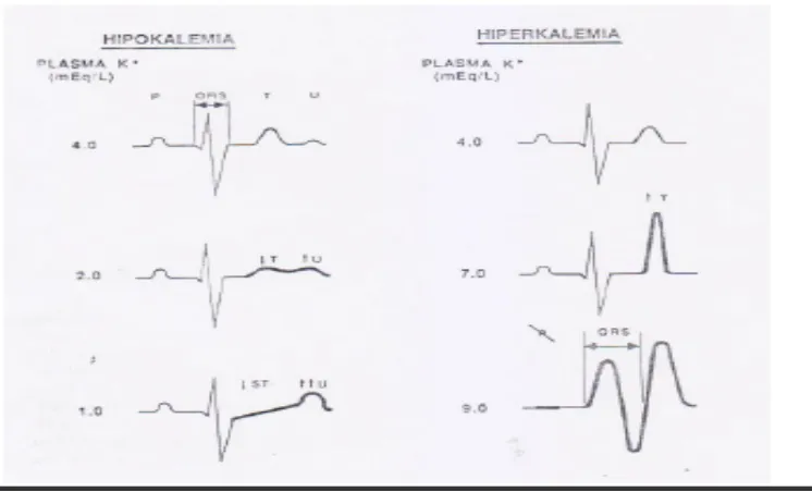 Gambar 3. Gambaran EKG pada gangguan kalium