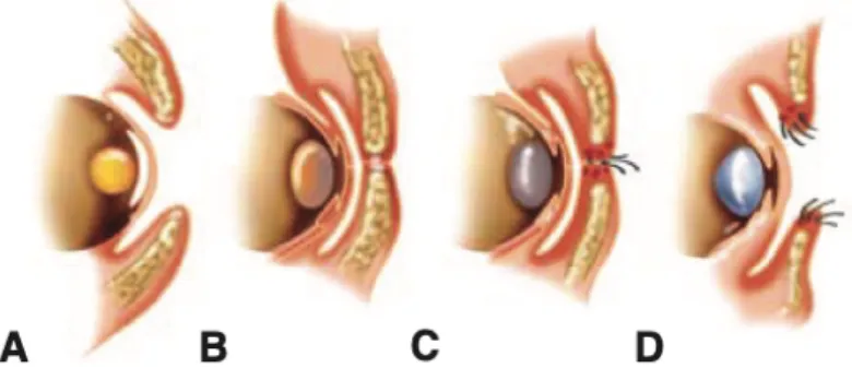 Gambar  2.8  Proses  pembentukan  kelopak  mata  dimulai  dari  (A)  pembentukan  kelopak mata atas dan bawah pada minggu ke-7