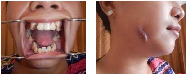Gambar 2. Inisial presentasi intra oral dan fistula kutaneus ekstra oral pada mandibula dextra 