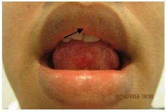 Gambar 2. Pandangan intra oral terlihat lesi pada ventral lidah diameter 1 cm, sewarna jaringan sekitar, batas jelas, kenyal dan bergerak 