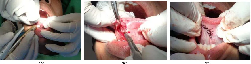 Gambar 3. (A) Anestesi lokal menggunakan sitojet (B) Insisi, deseksi dan eksisi seluruh jaringan mucocele (C) Penjahitan dengan benang silk interrupted suture