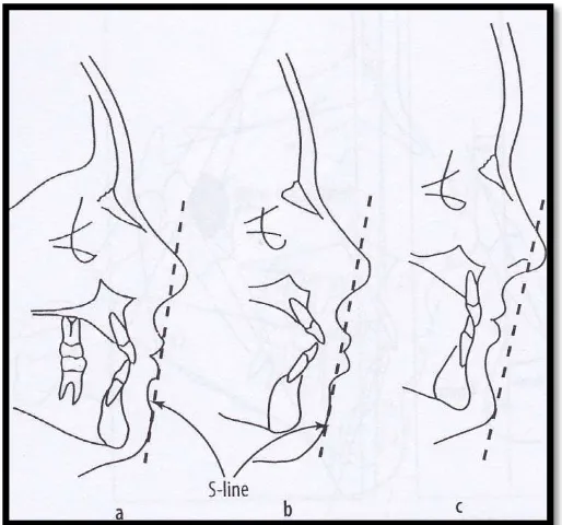 Gambar 10. Garis S (a) Ideal (b) Protrusif (c) Retrusif.10 