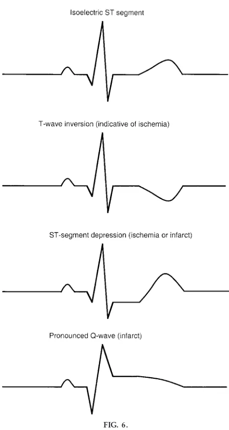 FIG. 6.Example of 1 normal (isoelectric) ECG tracing and 3