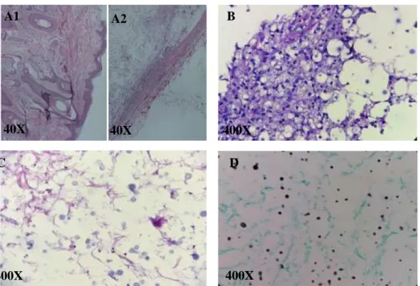 Gambar  4  Mikroskopis  jaringan.  A1  (H&amp;E):  Pelapis  epitel,  A2  (H&amp;E):  kapsul,  B&amp;C  (H&amp;E):  proliferasi jaringan ikat fibrous dan lemak yang disusupi oleh yeast, D (GMS): Yeast dengan ukuran  bervariasi bentuk bulat hingga crescentic