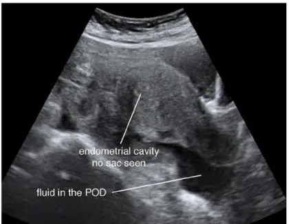 Gambar 7.5 Gambar USG menunjukkan tidak ada kantung  kehamilan di rongga rahim dan cairan di kantung Douglas