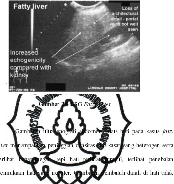 Gambar 2.4 USG Fatty Liver 