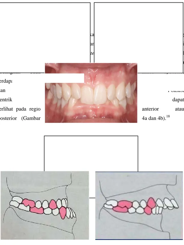 Gambar 2. Oklusi 18    (a). Prenormal     (b). Postnormal  (b)     18(a) 