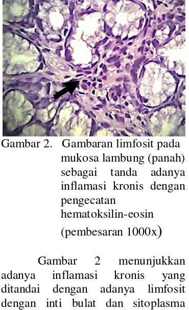 Gambar 2 adanya ditandai dengan adanya limfosit dengan inti bulat dan sitoplasma yang sedikit