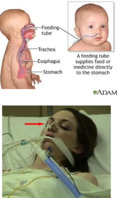 Gambar 32Pemakaian Feeding Tube pada Pasien Dewasa &amp; Bayi  10. Rectal Tube 