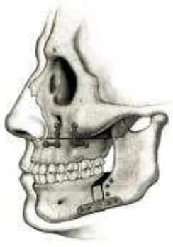 Gambar 3. Uvulopalatofaringoplasti (UPPP) 