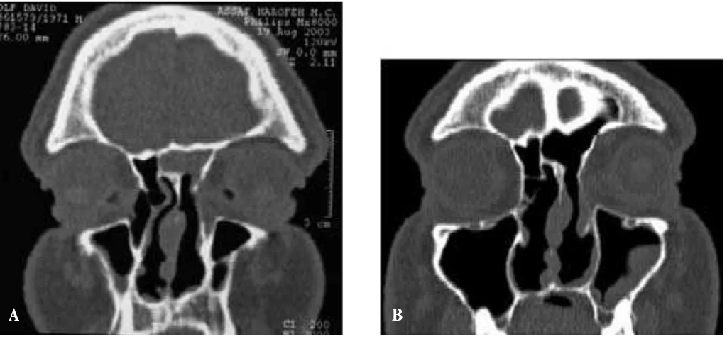 Figure 1A. Coronal CT scan of the left frontal sinusitis secondary to previous endoscopic sinus surgery.Figure 1B