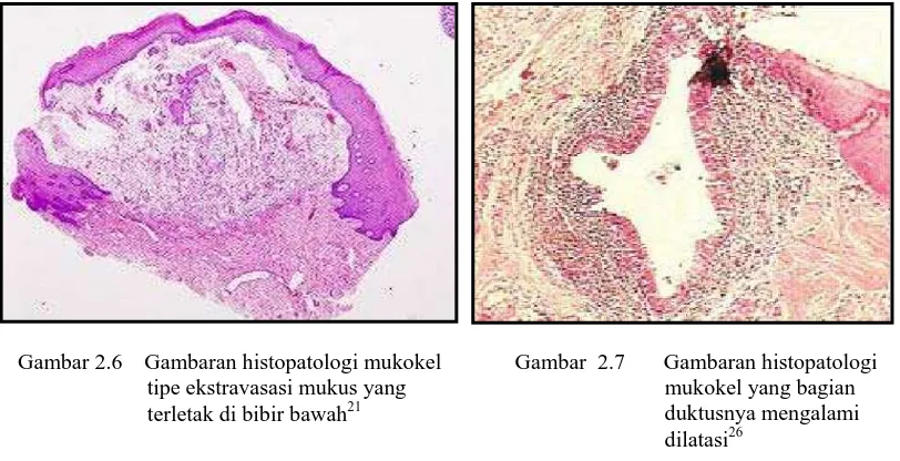 Gambar 2.6    Gambaran histopatologi mukokel                   tipe ekstravasasi mukus yang  