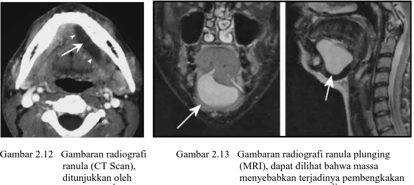 Gambar 2.13   Gambaran radiografi ranula plunging                                    hingga ke leher pasien                                 menyebabkan terjadinya pembengkakan                                   (MRI), dapat dilihat bahwa massa  31 