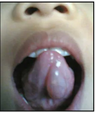 Gambar 3.1  Mukokel di ventral lidah 