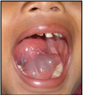 Gambar 3.3    Ranula di dasar mulut 